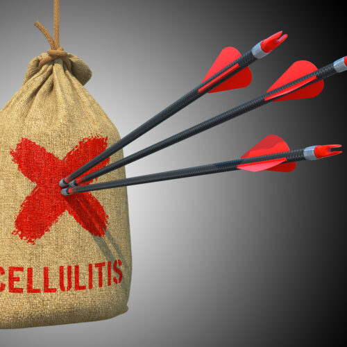 Cellulitis  Concept. Three Arrows Hit in Red Target on a Hanging Sack on Gray Background.