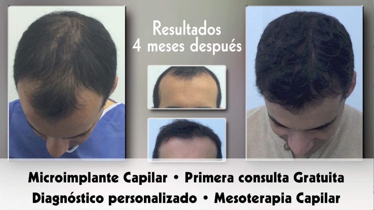 Nuestro protocolo la calvicie común o alopecia androgenética