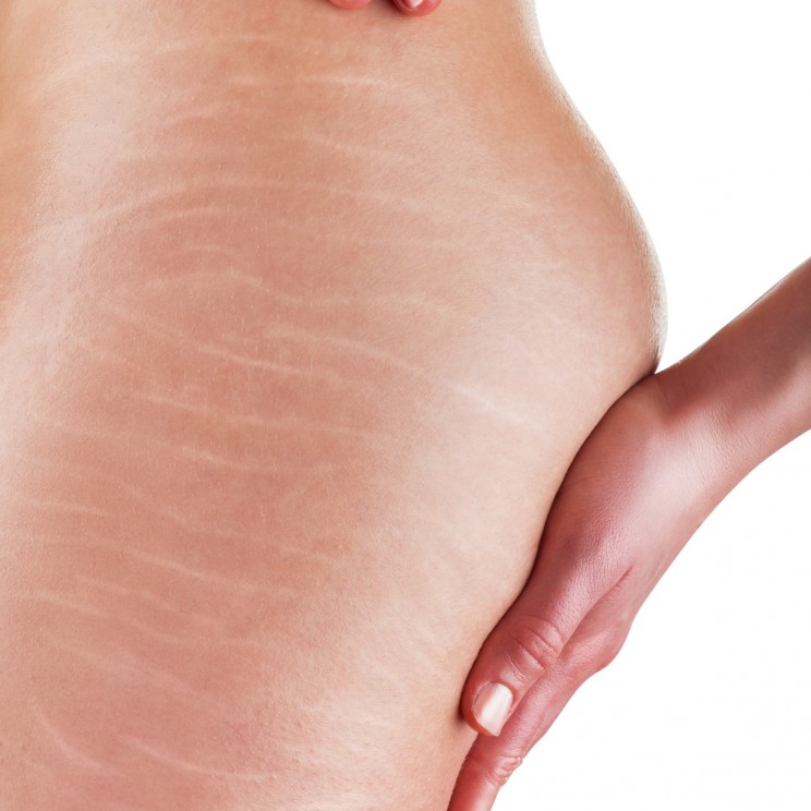 A woman is testing the skin on the thigh for the presence of stretch marks and cellulite