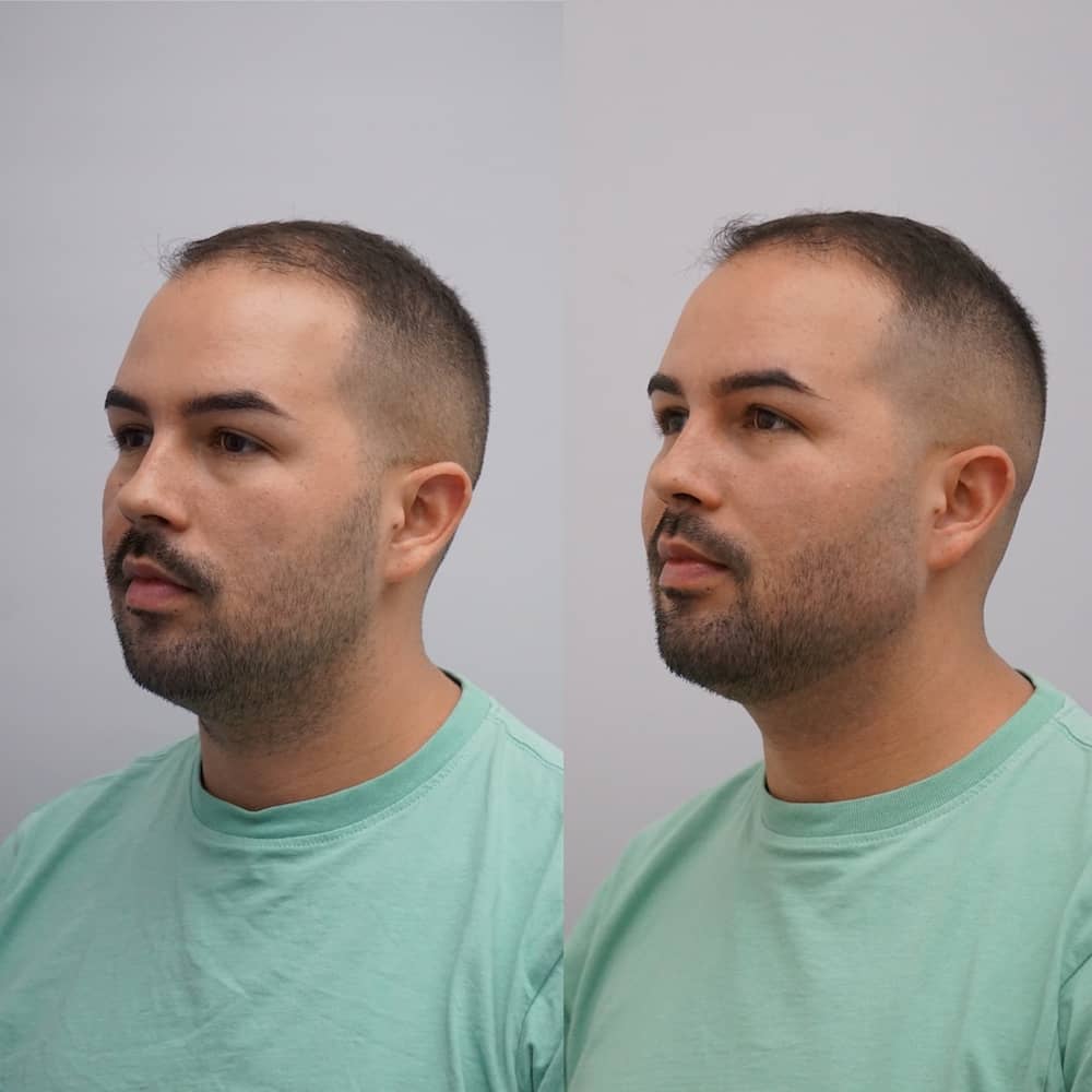Caso clínico armonización facial antes y después 1