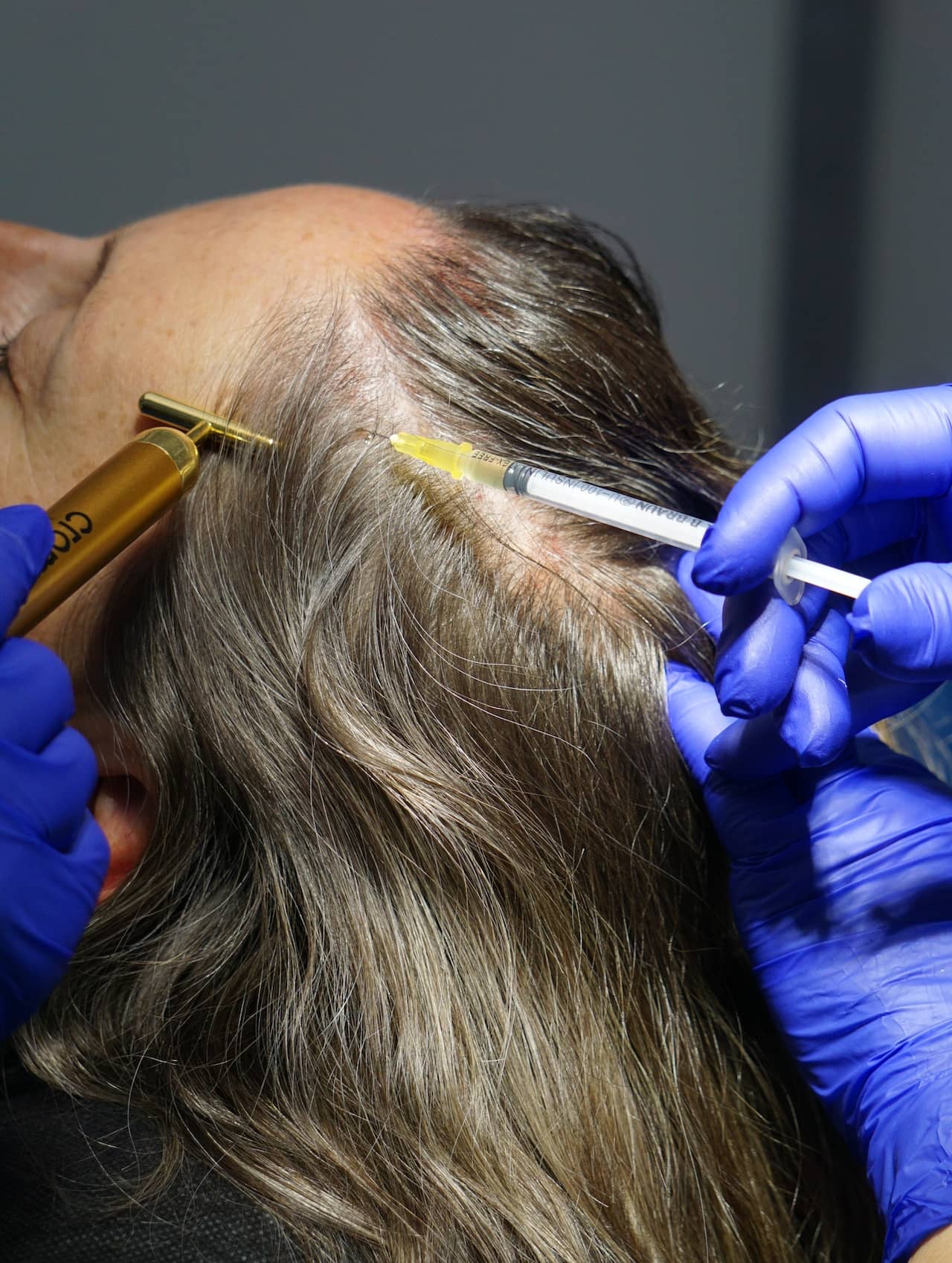 Alopecia en mujeres en Clínica Bonome
