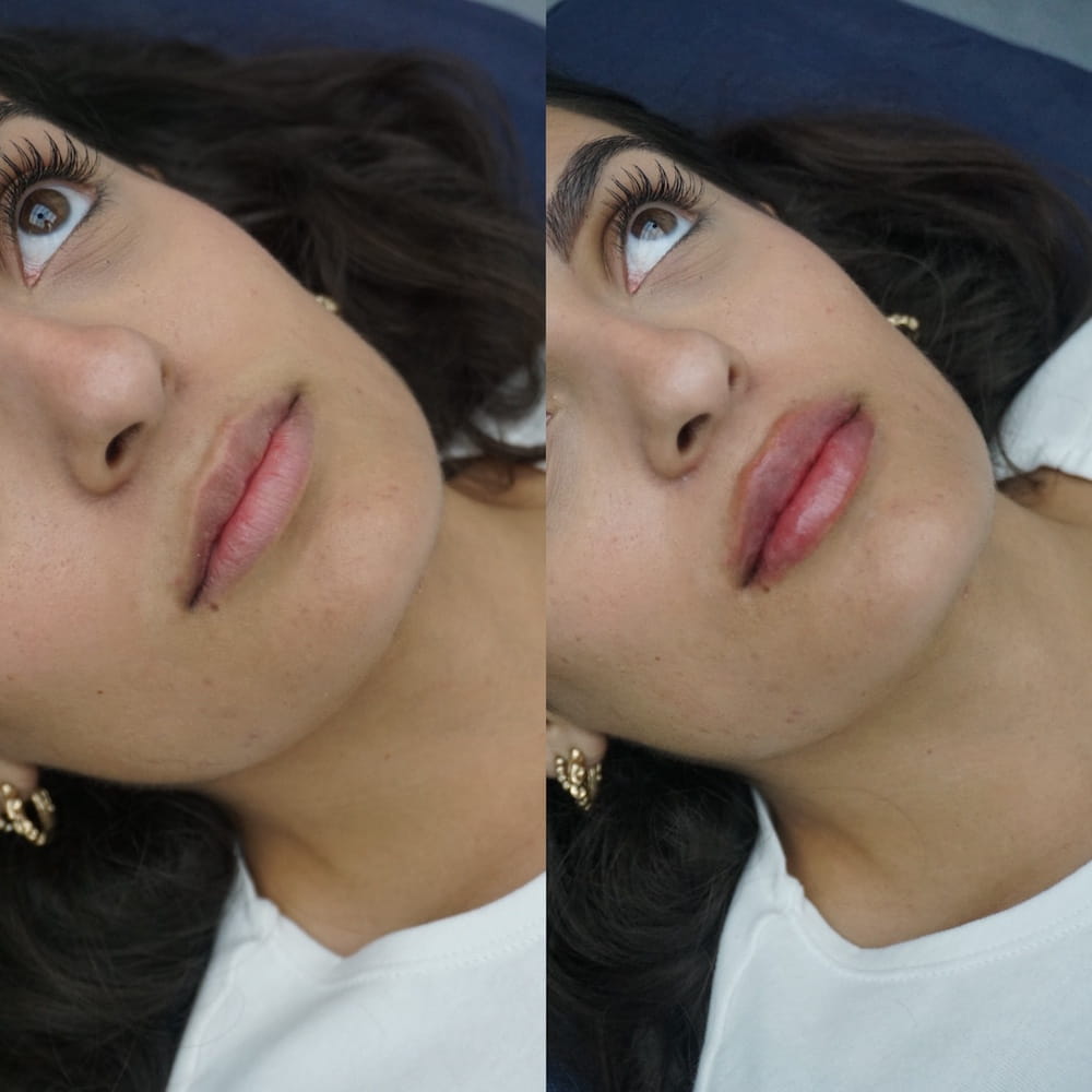 Caso clínico labios antes y después 3