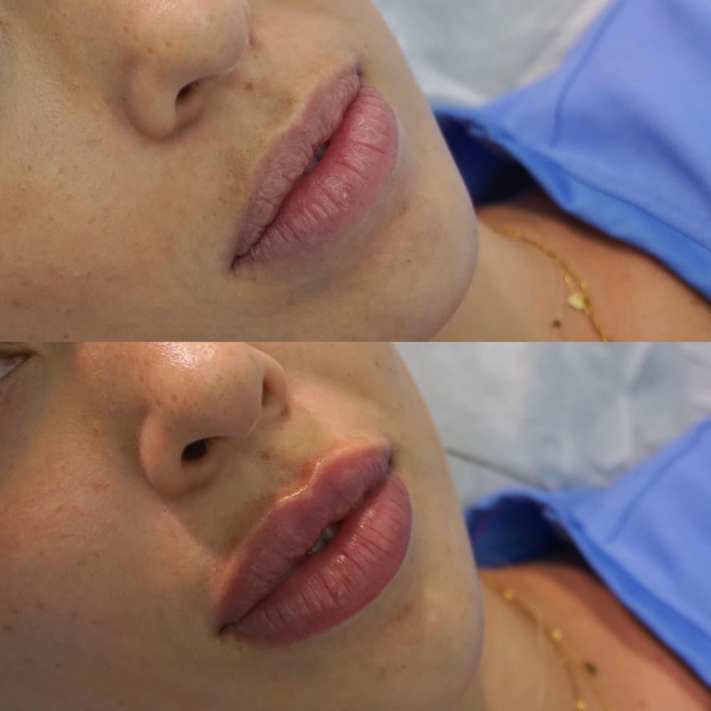 Caso clínico labios antes y después 4