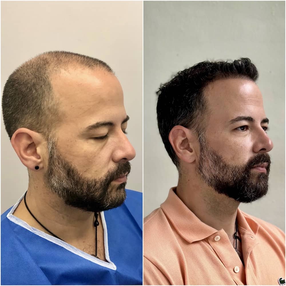 Caso clínico capilar antes y después 16