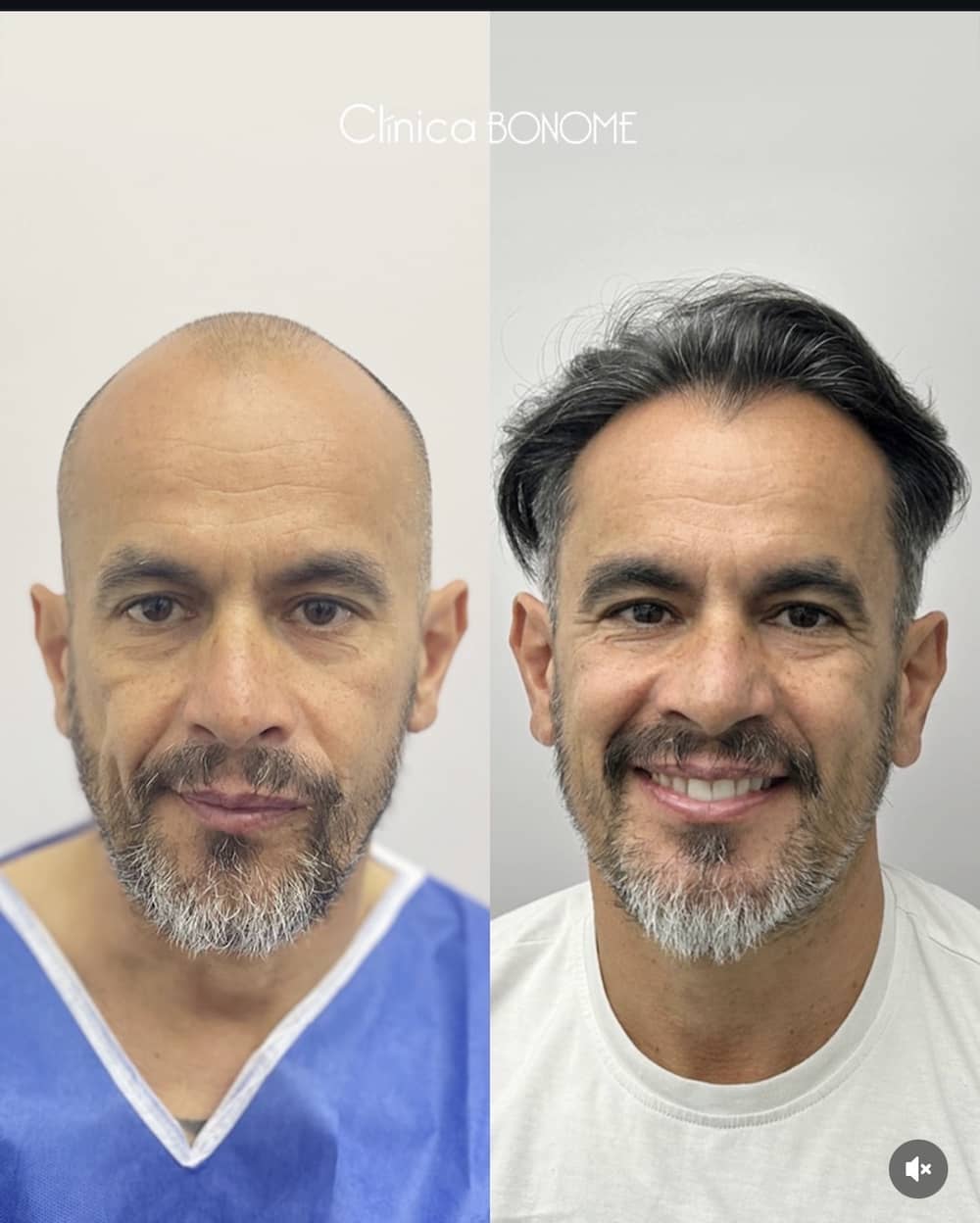 Caso clínico capilar antes y después 18