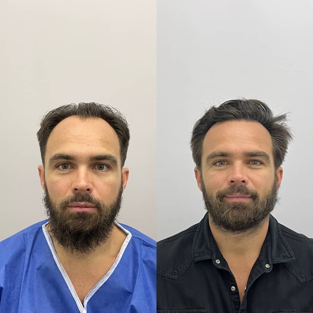 Caso clínico capilar antes y después 3