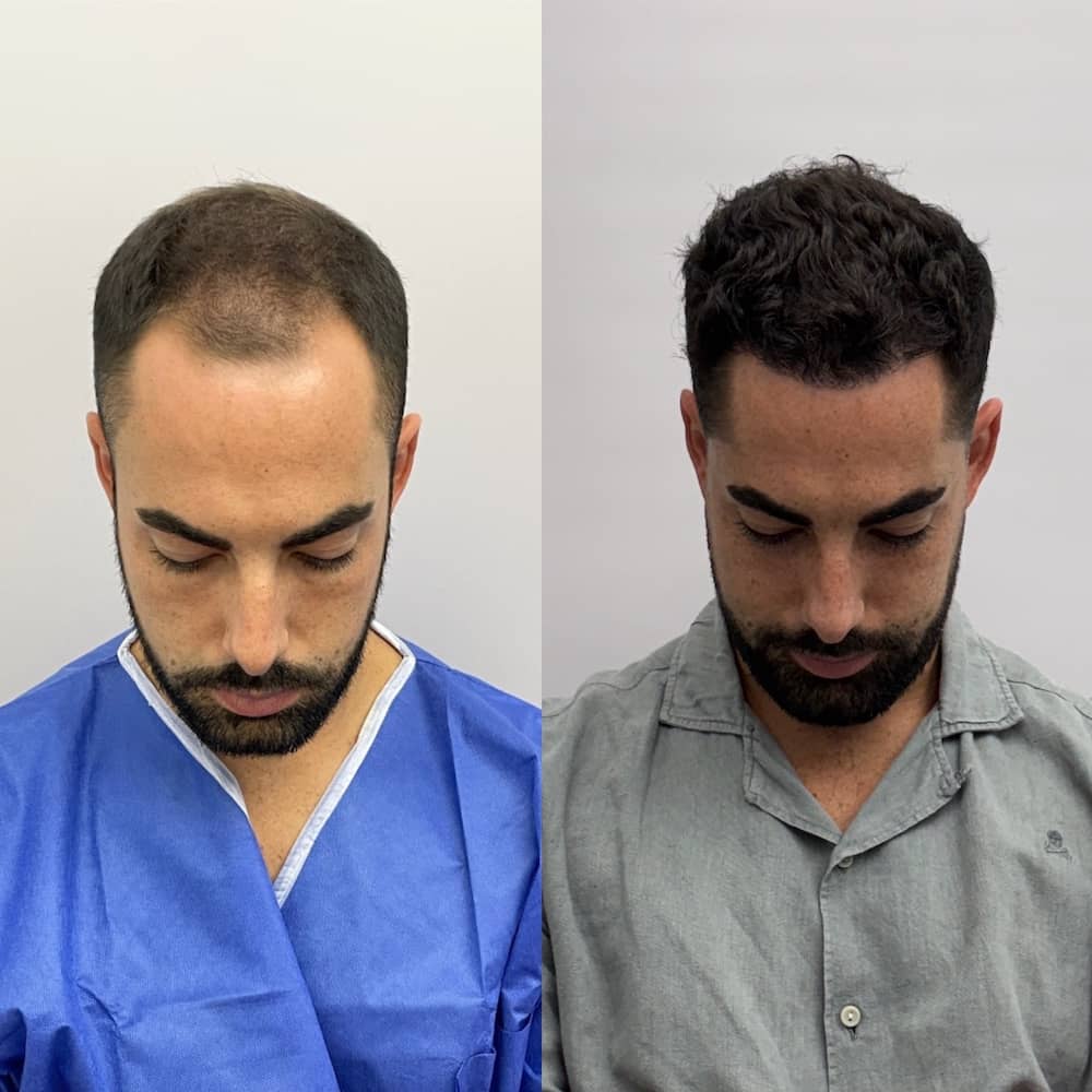 Caso clínico capilar antes y después 4