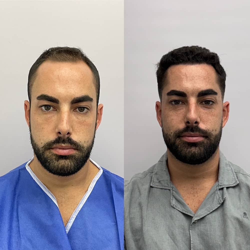 Caso clínico capilar antes y después 5