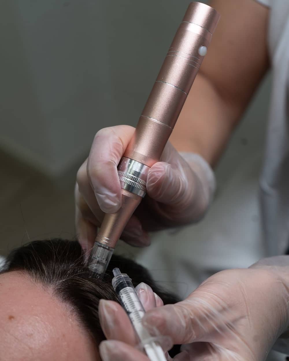 Exosomas Capilares en Clínica Bonome