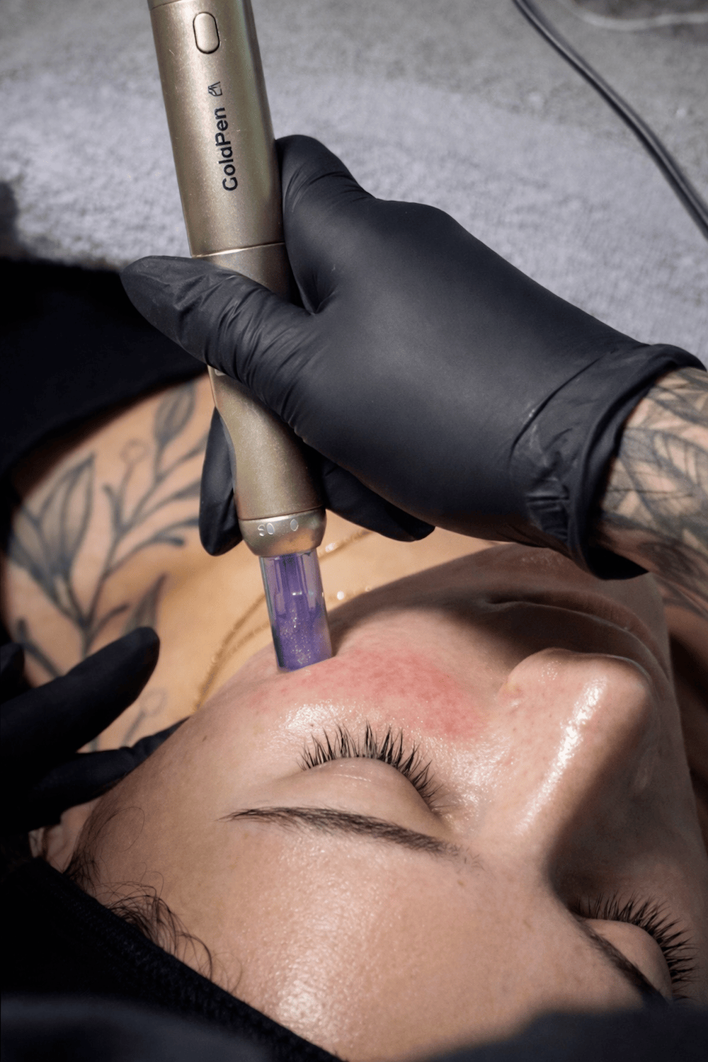 Exosomas y Dermapen en Clínica Bonome