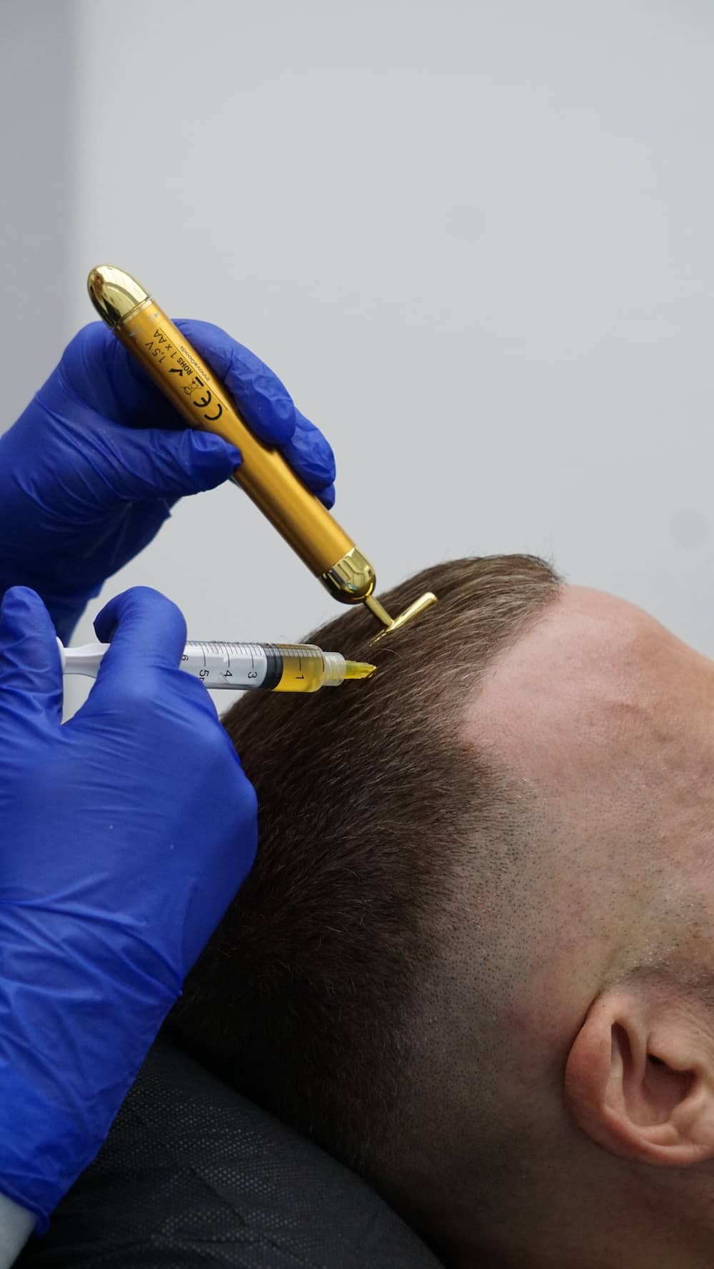 Tratamiento conservador capilar en Clínica Bonome