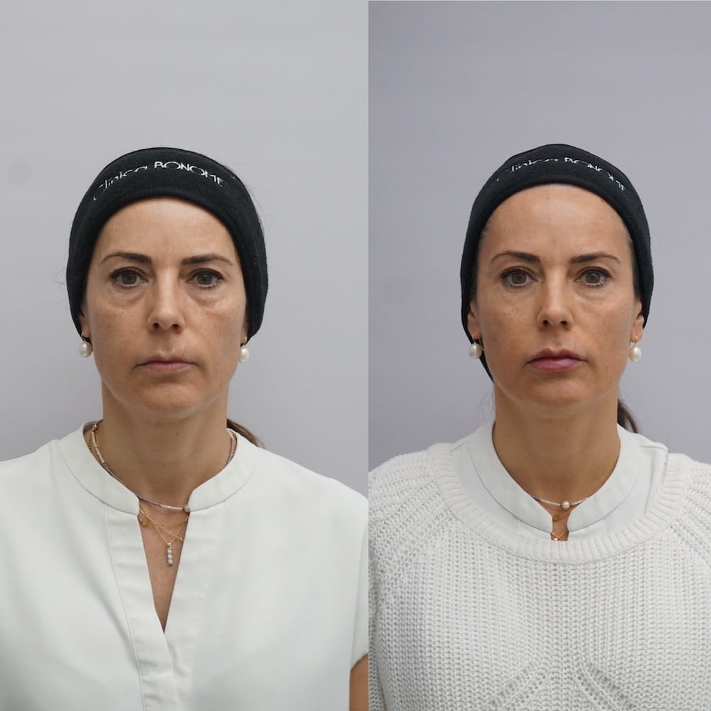 Caso clínico ojeras antes y después 1