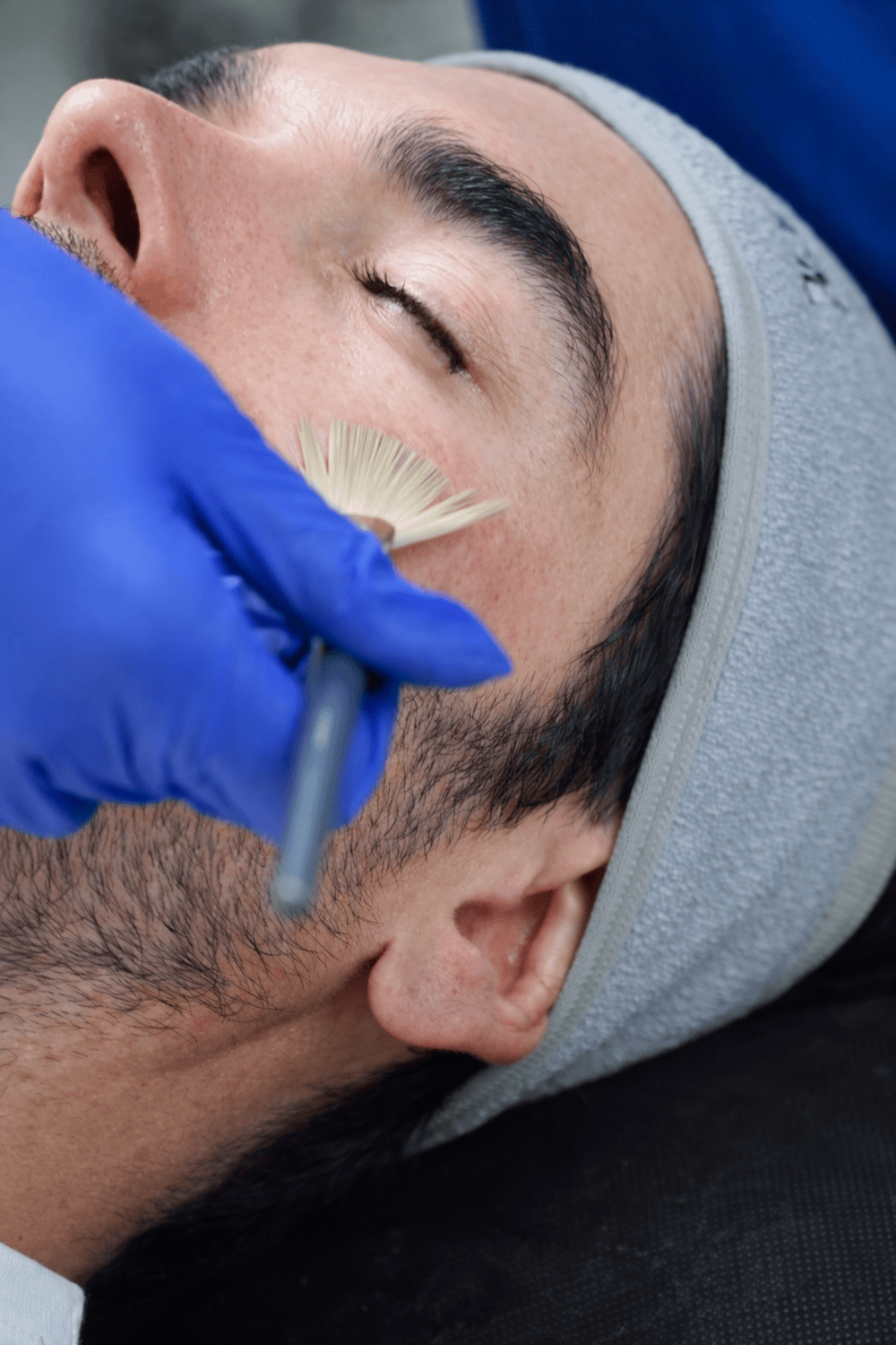 Peeling químico en Clínica Bonome